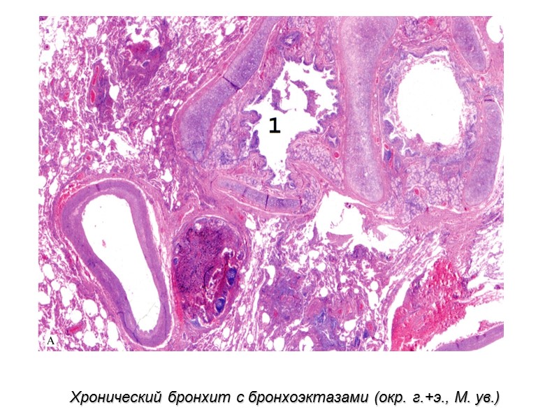 Хронический бронхит с бронхоэктазами (окр. г.+э., М. ув.)